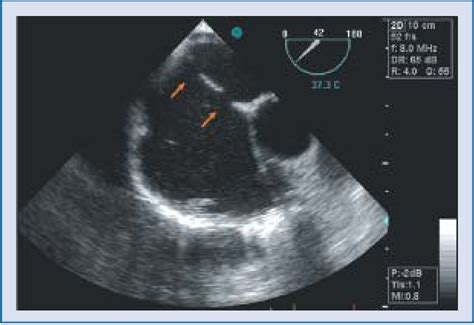 Figure 1 From A Failed Case Of Percutaneous Septal Closure Of