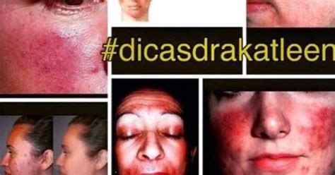 Dermatologista Em Pele Negra Ros Cea Comum Na Pele Negra