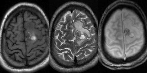 Brain Bleed: Brain Bleed On Mri