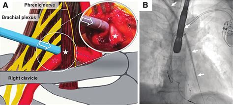 A Exposure Of The Right Subclavian Artery And Atlas Of Surrounding Download Scientific