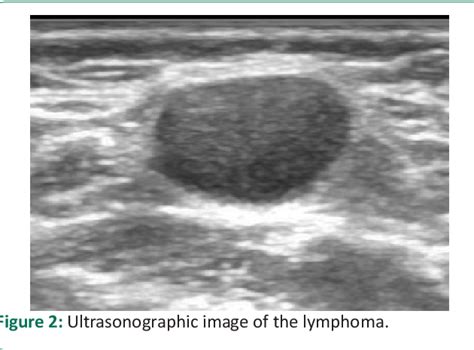 Table 1 From Evaluation Of Ultrasonographic Findings In Adults With Cervical Lymphadenopathy