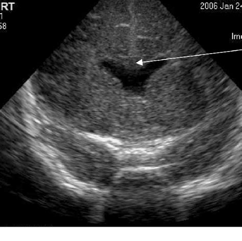 Absence Of Cavum Septum Pellucidum Related With Optic Nerve Hypoplasia