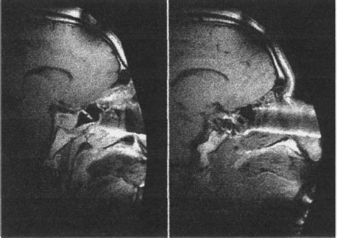 Sagittal T1 Weighted Magnetic Resonance Mr Imaging Guided Resection Download Scientific