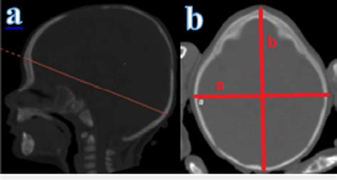 Cephalic index measurement a: cephalic index measurement plane in ...