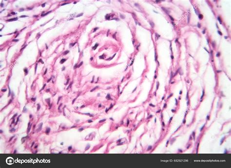 Photomicrograph Dari Sampel Jaringan Neurofibroma Pada Penyakit Genetik