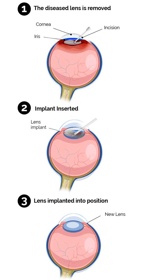 Cataract Surgery Management Gateway Eye Associates