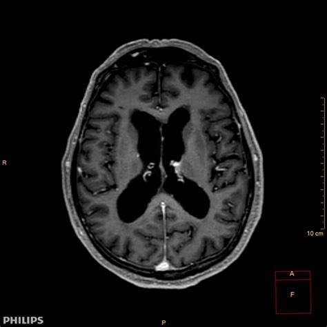 Transverse Longitudinal Relaxation Time T Gadolinium Enhanced