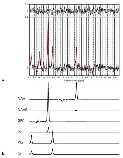 Magnetic Resonance Spectral Analysis Using The LCModel LCModel Fit Of