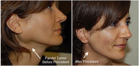 Salivary gland -Parotid gland/ submandibular | infiniaclinic