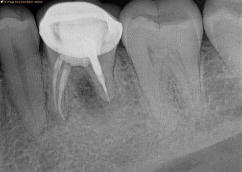 Boil On Gum After Root Canal Is That Normal 1311 Jackson Ave Dental