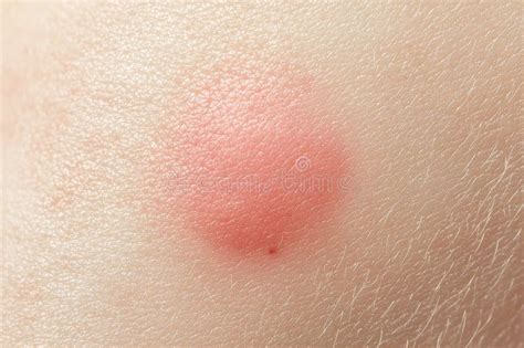 An Asian Child Has A Fungal Infection Called Tinea Corporis On Their