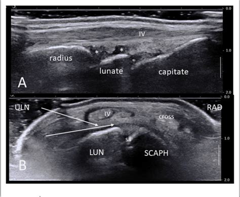 Figure 1 From Ultrasound Guided Synovial Biopsies Of Wrists