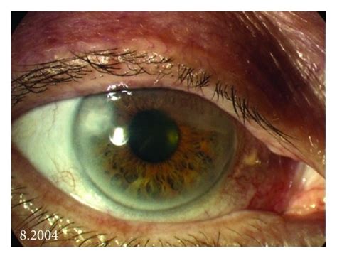 A An 86 Year Old Patient With A De Novo Temporal Conjunctival Download Scientific Diagram