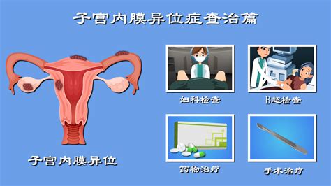 子宫内膜异位症 子宫内膜异位症的发病机制 子宫内膜异位症是怎么形成的 科普视频 在线问诊 深读视频 深度