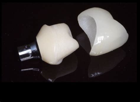 Vita Enamic Is Implant Abutment And Triluxe Crown Digital Enamel