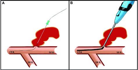 Schema Illustrating Percutaneous Perforation Closure Of An Iatrogenic