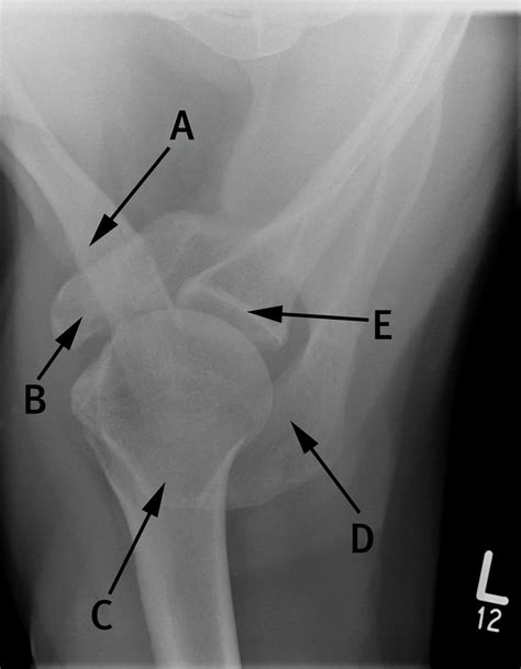 Axial view radiograph of the shoulder | The BMJ