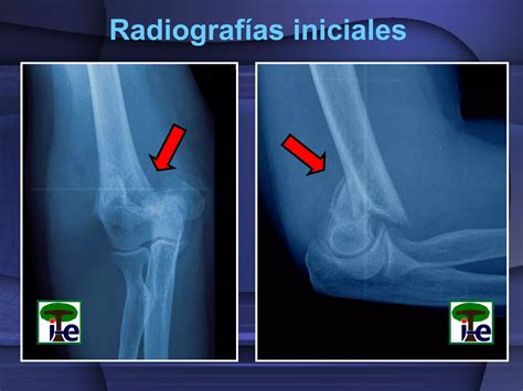 Fractura Supracondílea De Codo Ppt