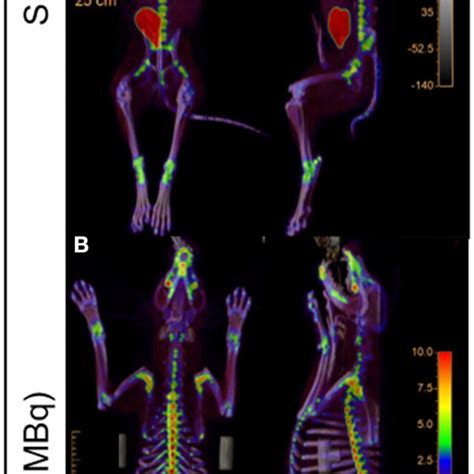 Representative whole body ¹⁸F NaF PET CT uptake fusion showing the