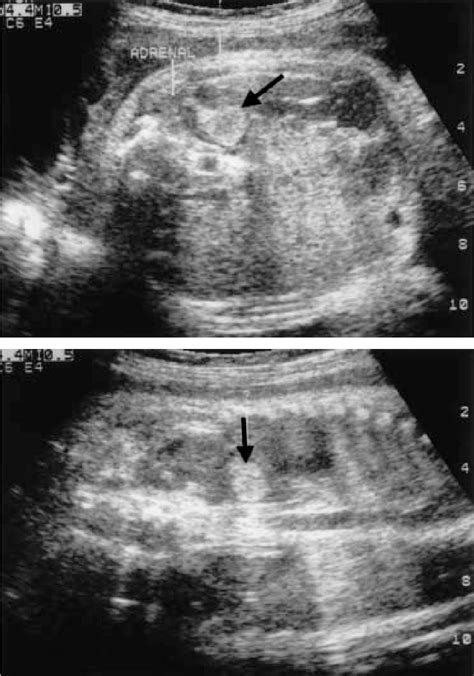 Figure From Prenatal And Postnatal Imaging Findings Of Congenital