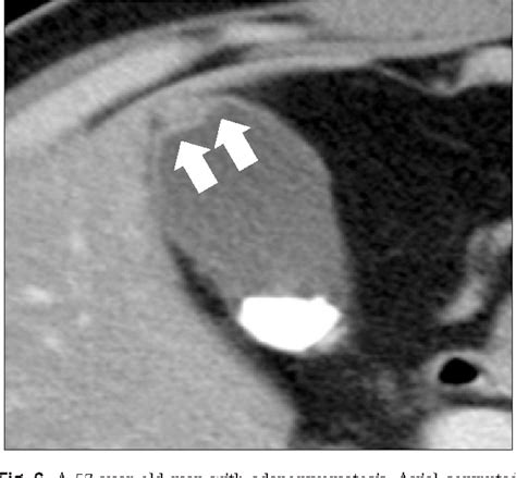 Pdf Focal Thickening At The Fundus Of The Gallbladder Computed