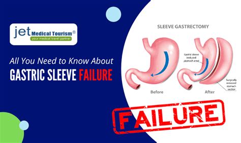 Gastric Sleeve Failure Can A Gastric Sleeve Be Redone Gastric