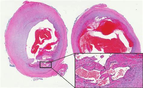 Histological Features Of Ipeh Showing Endothelial Cell Proliferation