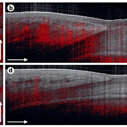 Vascular features of nail psoriasis in the proximal nail fold. Arrows ...