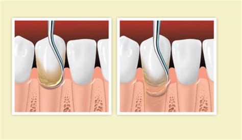 What Is Subgingival Curettage News Dentagama