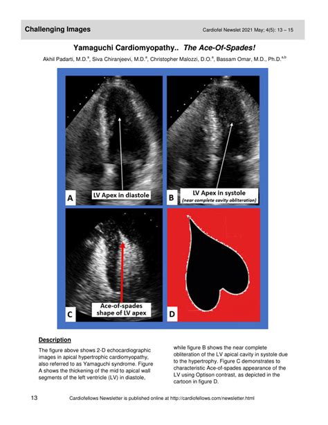 (PDF) Yamaguchi Cardiomyopathy.. The Ace-Of-Spades!