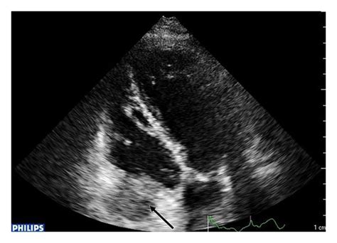 Hypoechoic mass involving tricuspid annulus. Echocardiography apical ...