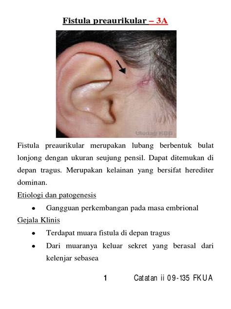 Preauricular Fistula Etiology Clinical Features Diagnosis And