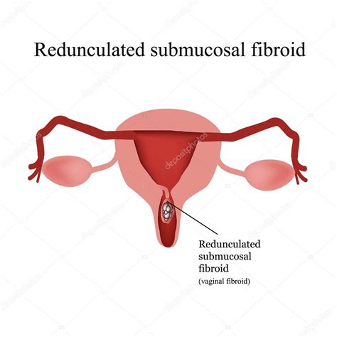 Pedunculated Submucous Uterine Fibroids Vaginal Fibroids Infographics