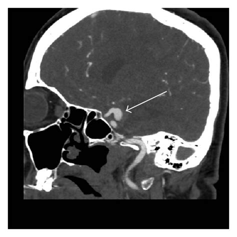 Preoperative Ct Angiogram Ct Computed Tomography Cta Computed