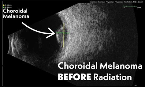 Choroidal Melanoma Ultrasound