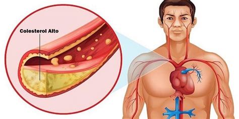 As Principais Causas Do Colesterol Alto Atualizado Hot Sex Picture