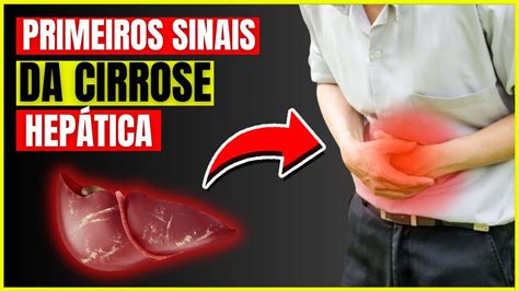 Cirrose Hepática Será Que Você Está Ignorando Esses Sinais Cruciais