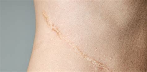 How To Treat Scars At Home And Hopefully Make Them Disappear