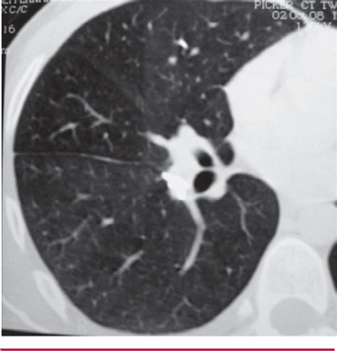 Figure 2 From Pulmonary Embolism Of Polymethyl Methacrylate Semantic