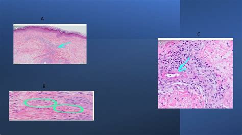 Skin Punch Biopsy Findings After Several Relapses A Superficial