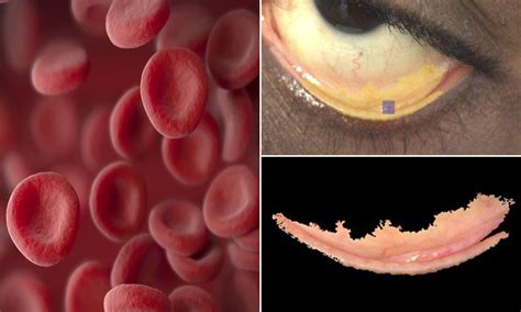 Iron Deficiency Anemia Eyes