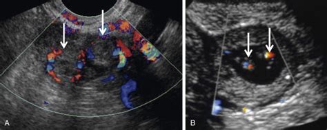 Ectopic Pregnancy Radiology Key