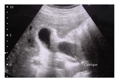 Us Findings Showing A Bilobar” Gallbladder Download Scientific Diagram