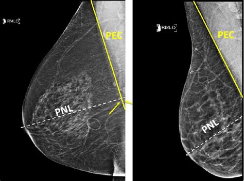 Example of adequately and inadequately positioned mediolateral-oblique ...