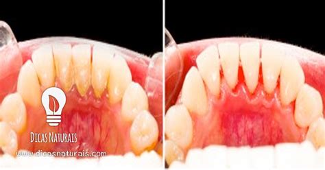 Como Remover A Placa Bacteriana Em 5 Minutos Sem Ir Ao Dentista Teeth