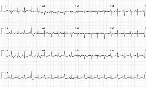 S1Q3T3 pattern leading to early diagnosis of pulmonary embolism | BMJ Case Reports