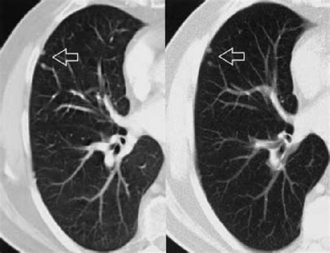 5mm Lung Nodule Right