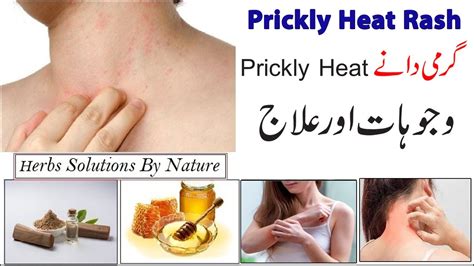 Garmi Dano Ka Ilaj Prickly Heat Treatments Causes What Causes