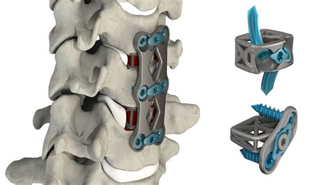 Web Medical Commercially Introduces New Cervical Spine Plate