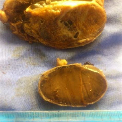 Cut Section Of Speciment Revealed A Torsed Testis And Circumscribed